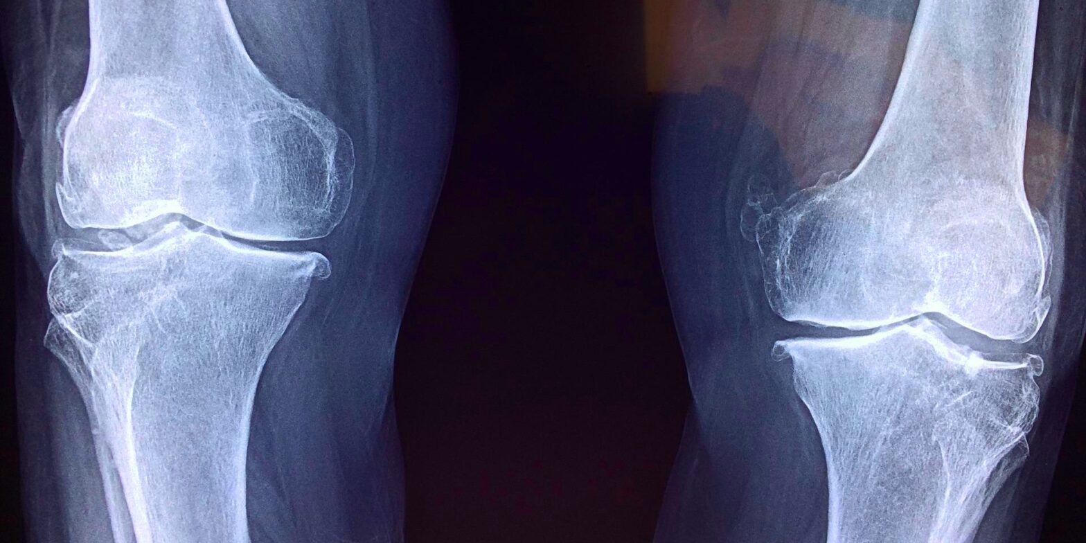 Alexander Technique osteoarthritis knees